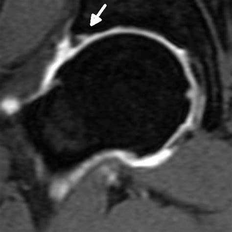 Acetabular Labrum Mri