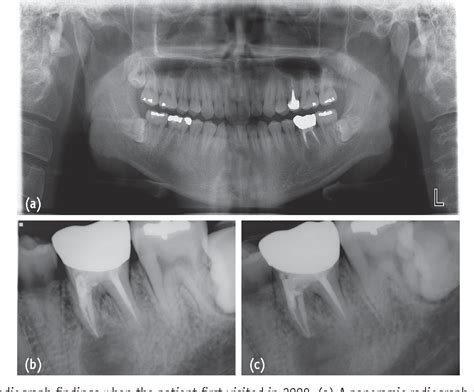 Figure 1 From Progression Of Periapical Cystic Lesion After Incomplete