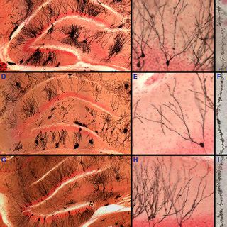 Bilateral Transplantation Of Human Neural Stem Cells HNSCs Preserves