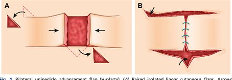 Flap Basics II: Advancement Flaps. | Semantic Scholar