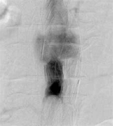 Figure 1 From Management Of A Large Intraoperative Type Iiib Endoleak