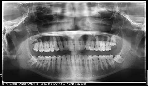 Wisdom Teeth Too Close To My Nerves What Do Yall Think 2d Xray Rwisdomteeth