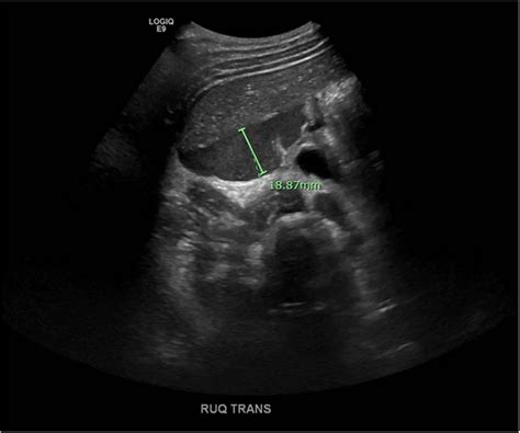 Right Upper Quadrant Transabdominal Ultrasound Demonstrating Complex