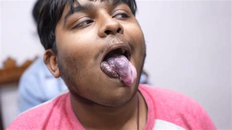 Poor Boy With Large Hemangioma In Tongue And Lips YouTube