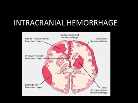 Types Of Intracranial Hemorrhage