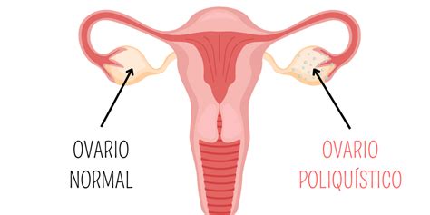 Sop Síndrome De Ovario Poliquístico