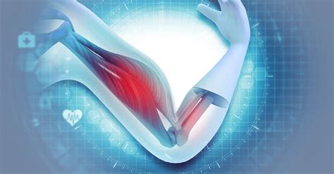 Acute repair of distal biceps tendon rupture may have advantages vs ...