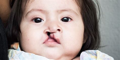 Cleft Lip: Causes, Treatment | ECLR — Early Cleft Lip Repair