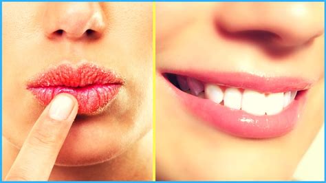 Chapped Lips Home Remedy Natural Remedies For Chapped Lips