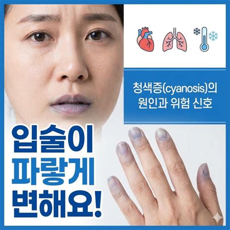 cyanosis