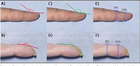 Figure 3 From Expert Review Examination For Finger Clubbing Semantic