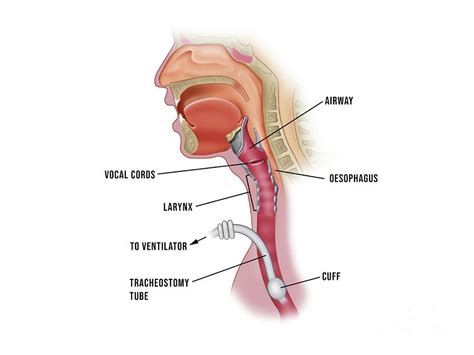 Tracheostomy Airway Tube By Maurizio De Angelis Science Photo Library