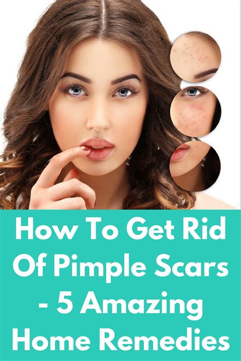 Pin On How To Get Rid Of Pimples