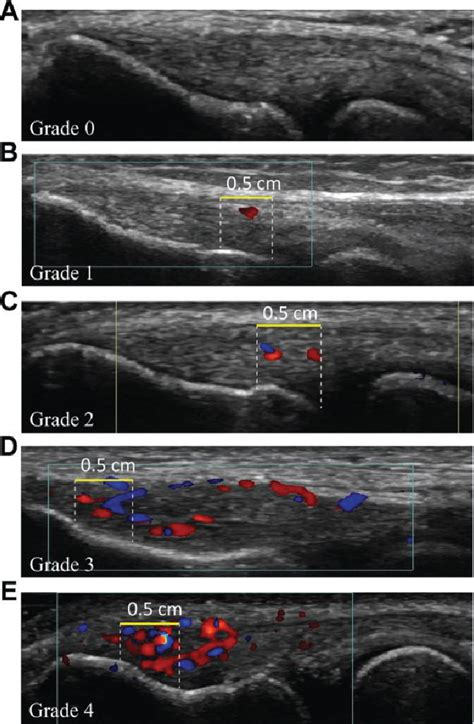 [pdf] Ultrasonographic Characteristics Of The Common Extensor Tendon Of The Elbow In