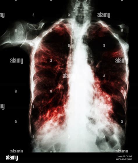 Pulmonary Tuberculosis Film Chest X Ray Interstitial Infiltrate