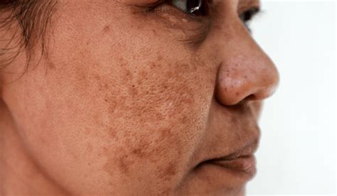 Peeling para melasma O que você precisa saber sobre o tratamento