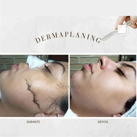 Dermaplaning Quanto Tempo Dura - Dermaplaning Preço Quanto Custa e Se Vale a Pena: A Verdade de 2026