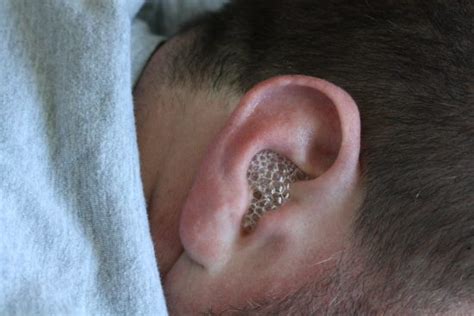 Ear Canal Infection Causes Picture Symptoms And Treatment