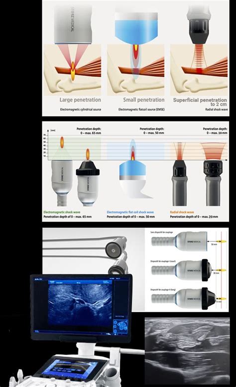 Extracorporeal Shockwave Therapy Eswt Epat In Nyc Nydnrehab