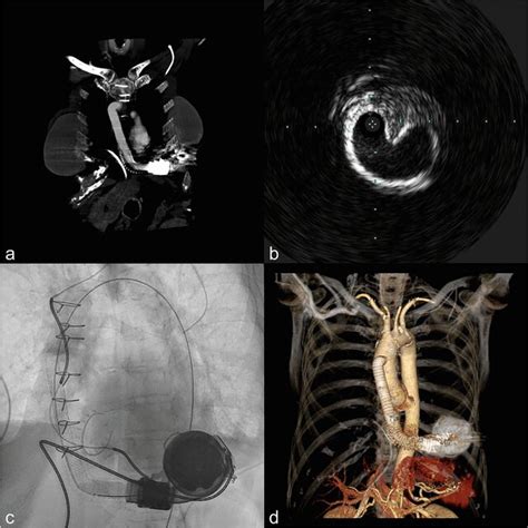 Lvad Driveline Infection With Intrathoracic Extension A Ct Image Shows