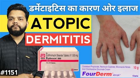 Atopic Dermatitis In Hindi Causes Symptoms And Treatment Youtube