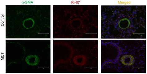 Pulmonary Artery Smooth Muscle Cell Pyroptosis Promotes The