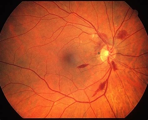 Retinal Flame Hemorrhage