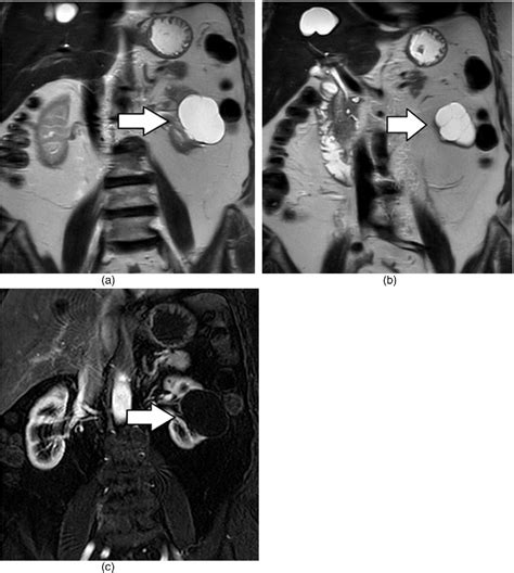 Figure From Cross Sectional Imaging Assessment Of Renal Masses With