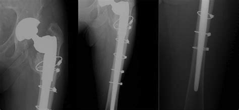 Periprosthetic Fractures Bone Joint