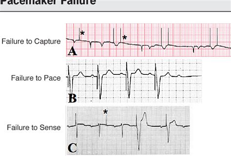 Figure 5 From Managing Pacemaker Related Complications And Malfunctions