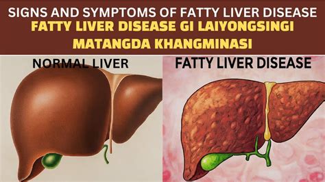 Fatty Liver Disease Gi Laiyongsingi Matangda Khangminasi Manipuri Youtube