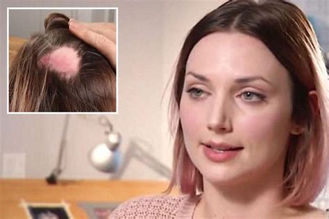 Woman S Scalp Left With Horrific Chemical Burns After £130 Dye Job Disaster The Irish Sun