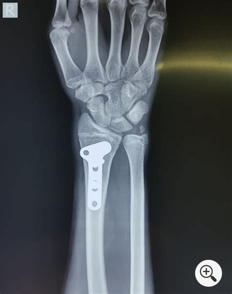 Distal Radius Fractures Broken Wrist Trauma Surgery