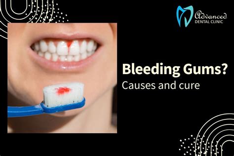 Bleeding Gums Treatment Delhi: Cause & Cure for Bleeding Gums