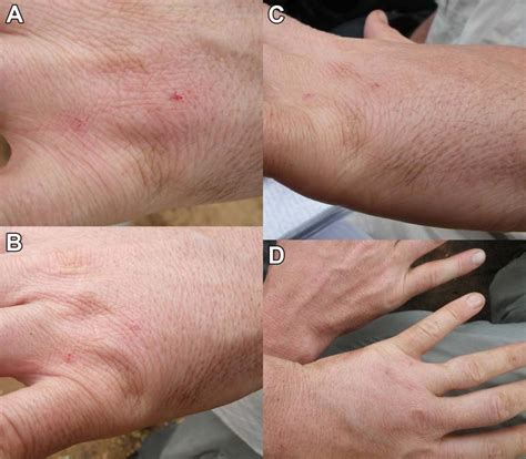 Photographs Showing The Local Symptoms Experienced By Lv From