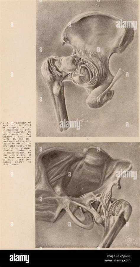 Congenital Dislocation Of The Hip Hi Res Stock Photography And Images