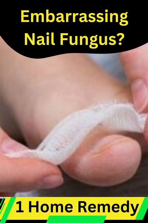 Natural Toenail Fungus Remedy Artofit