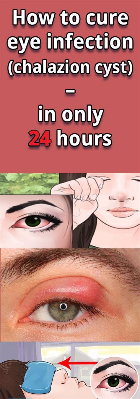 How To Cure Eye Infection Chalazion Cyst In Only 24 Hours Healthylife