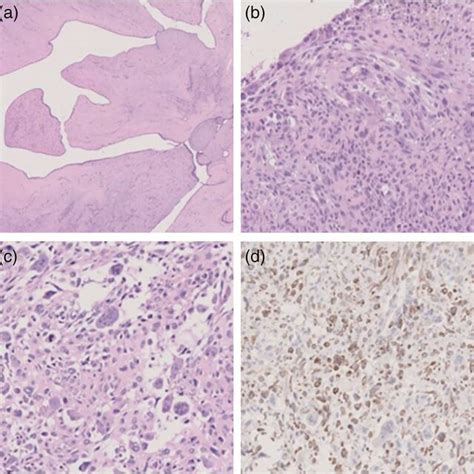 Pathology And Immunohistochemistry Examination Of The Lms‐ogc A Download Scientific Diagram