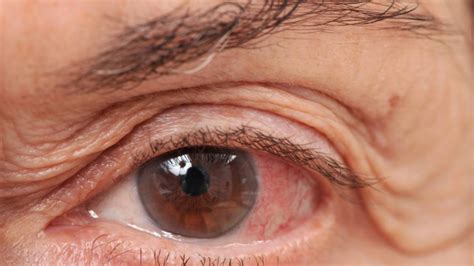 ¿qué Es El Glaucoma Conocé Más De La Enfermedad Silenciosa Que Ataca