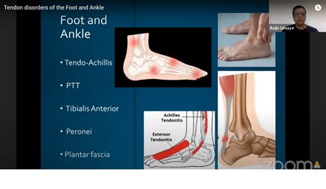 Tendon And Ligament Disorders