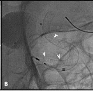 Digital Subtraction Angiography DSA Of Left Internal Cerebral Artery