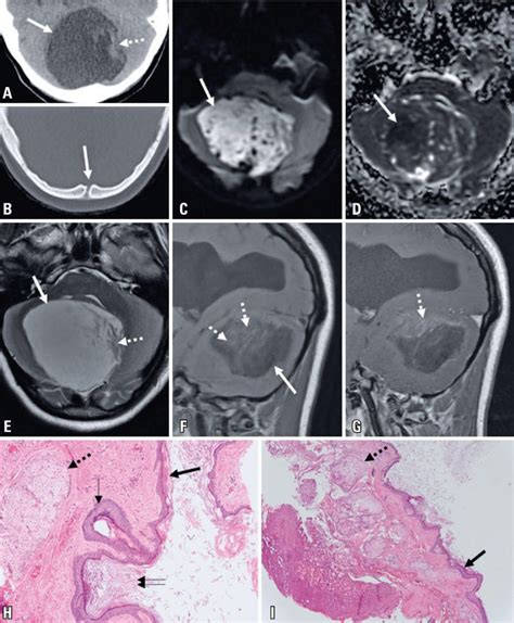 A T1 Hypointense Intracranial Dermoid Cyst Einstein São Paulo