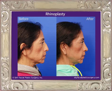 Rhinoplasty Nose Job San Diegos Best Rhinoplasty Surgeon — Sky