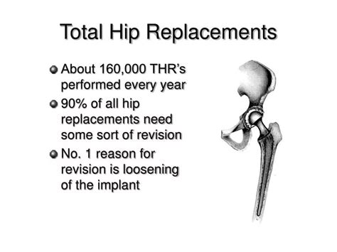 Ppt Total Hip Replacements Powerpoint Presentation Free Download