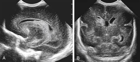 Premature Birth Rule Out Germinal Matrix Hemorrhage Radiology Key