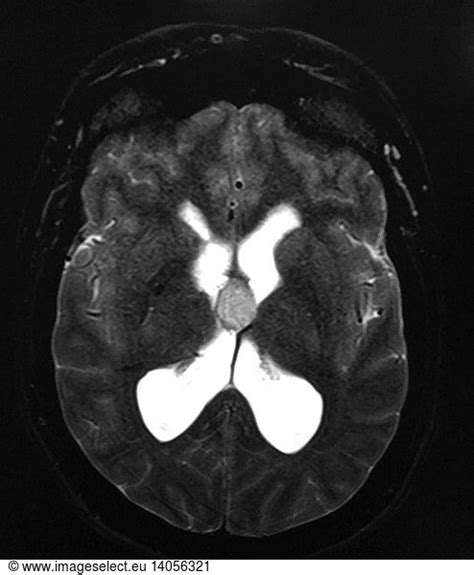 Imaging Of Colloid Cyst Imaging Of Colloid Cyst Mriabnormalheadabnormal Rights Managed