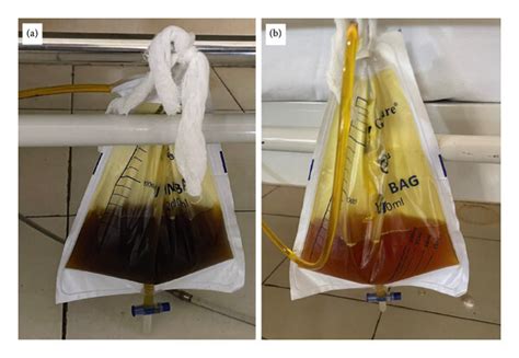 Urine collected on day 1 and day 3 since presentation legends. (a ...