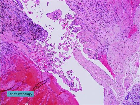 Qiao S Pathology Digital Intravascular Papillary Endothelial