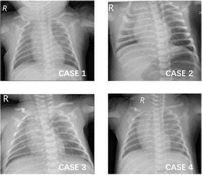 Frontiers Case Report Acute Hepatitis In Neonates With Covid